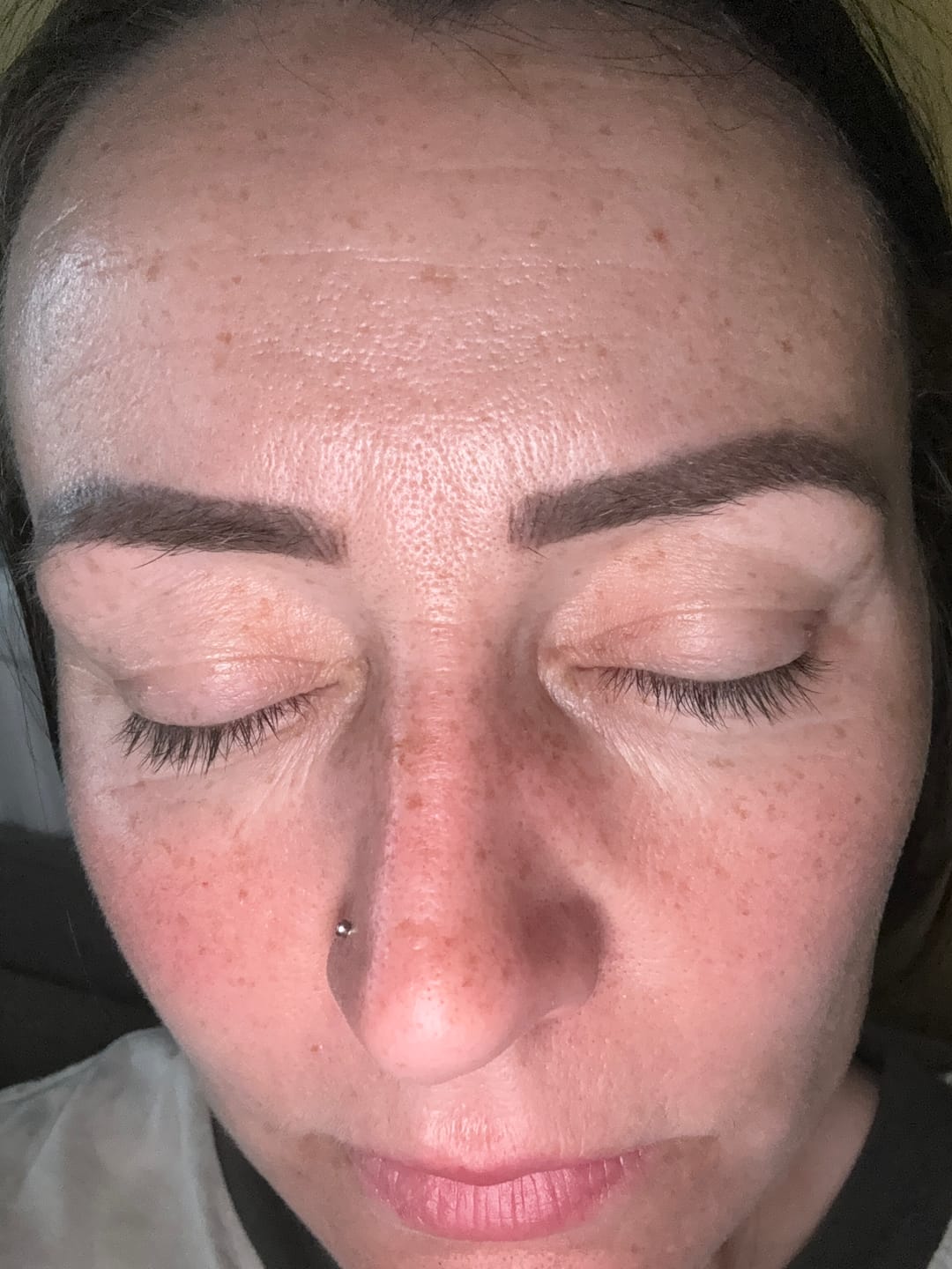 Customer photo review of The Micro Infusion System™