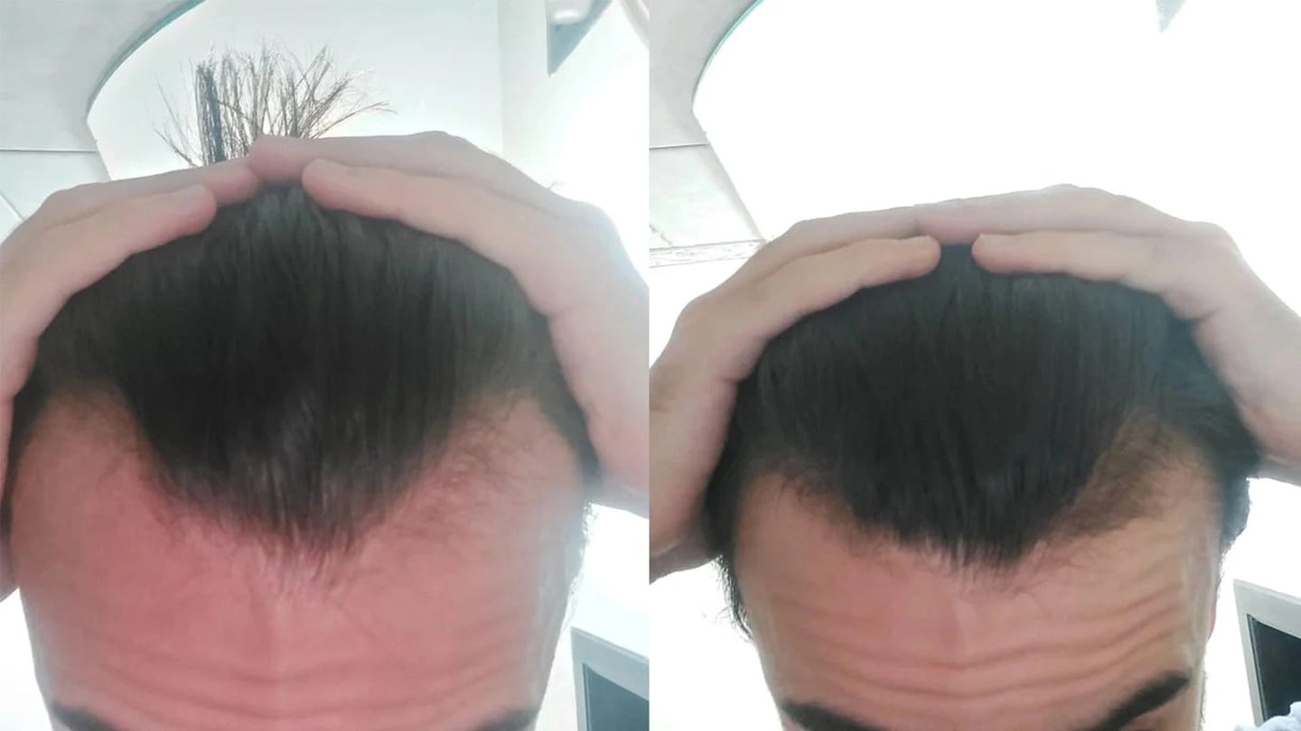 Customer photo review of Apex Hair Growth System