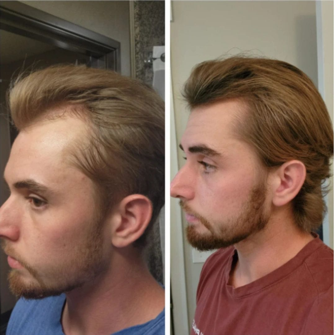 Customer photo review of Apex Hair Growth System