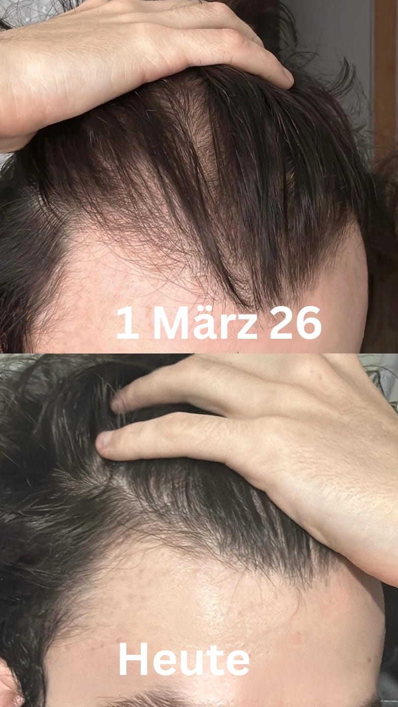 Customer photo review of Apex Hair Growth System