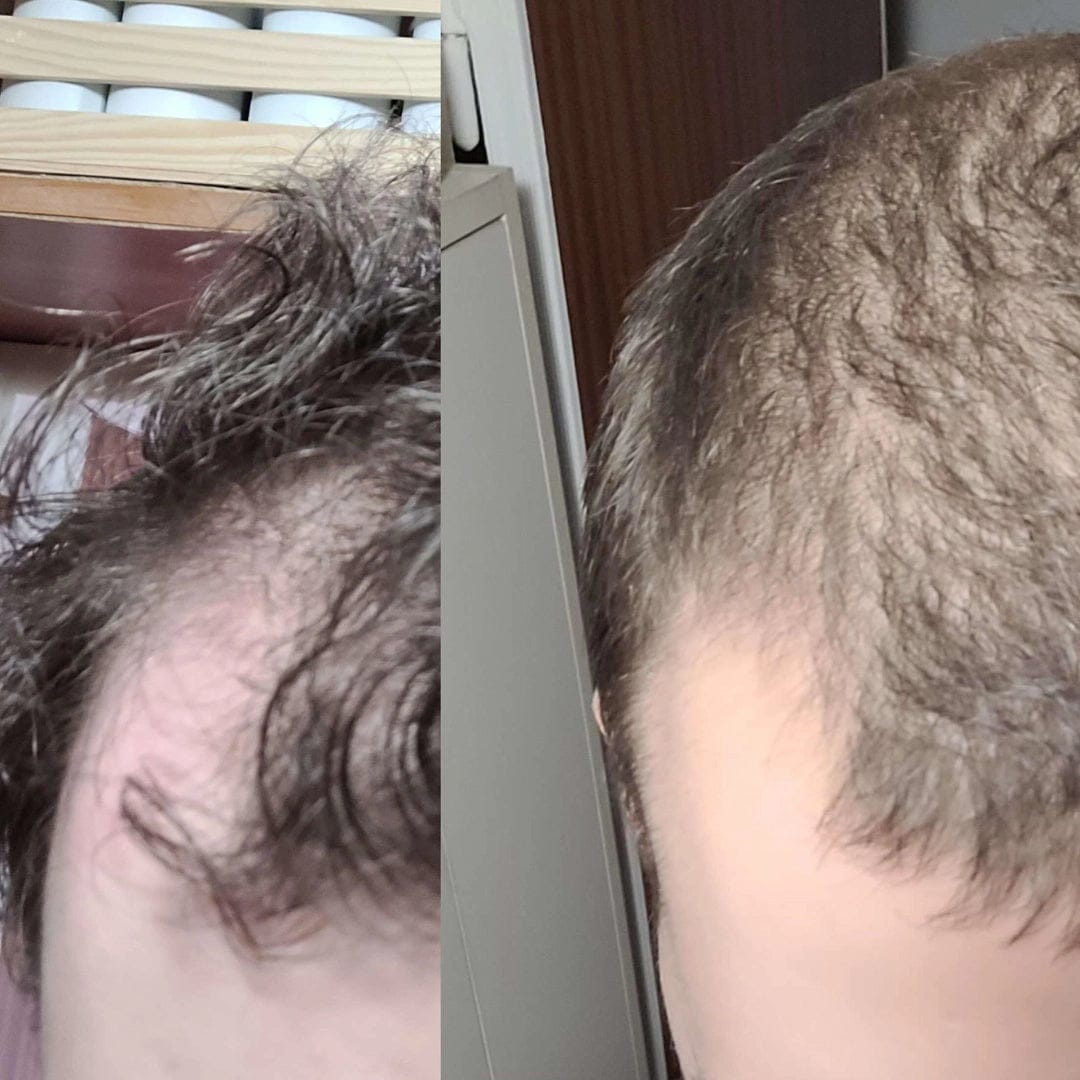 Customer photo review of Apex Hair Growth System