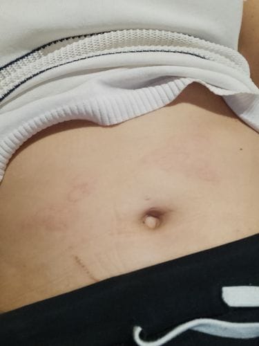 Customer photo review of ZOMACTON | Hormona de crecimiento (Somatropina) 15ui