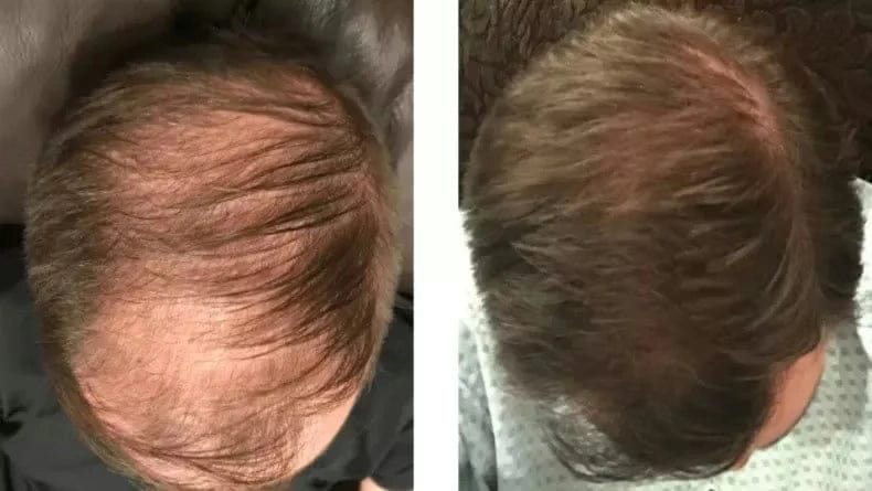 Customer photo review of Apex Hair Growth System