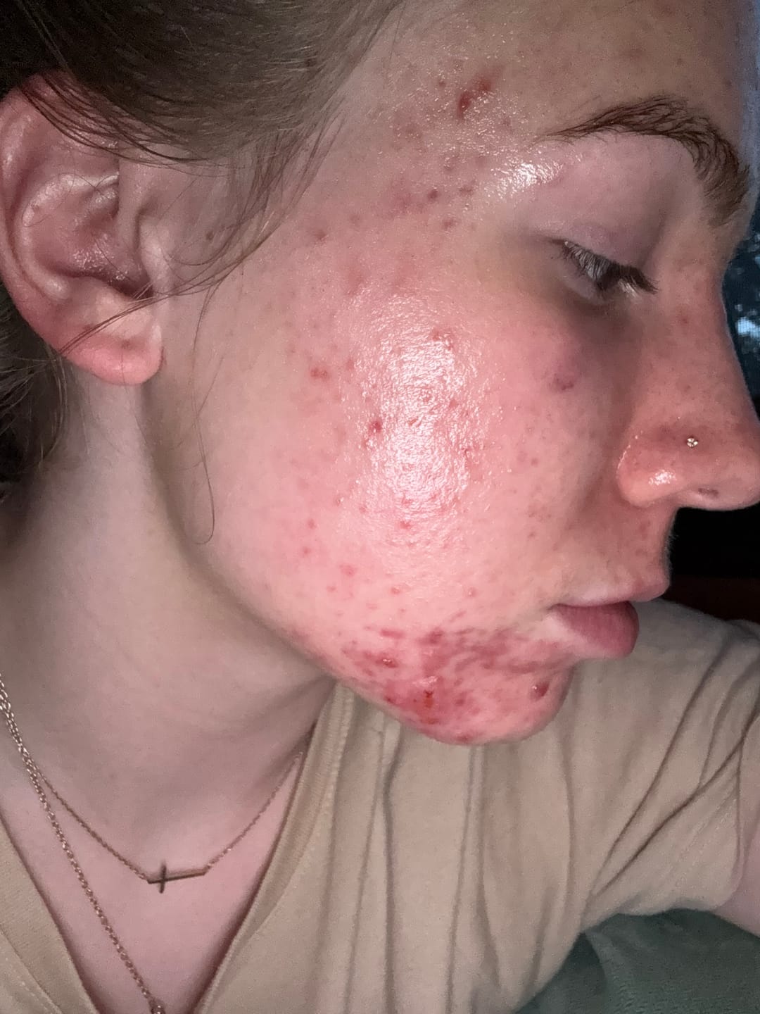Customer photo review of The Complete Acne Killer System 2.0