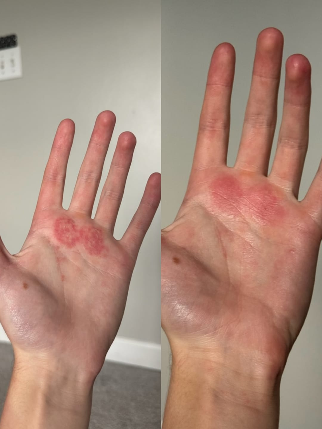 Customer photo review of Eczema Scratch Mitten