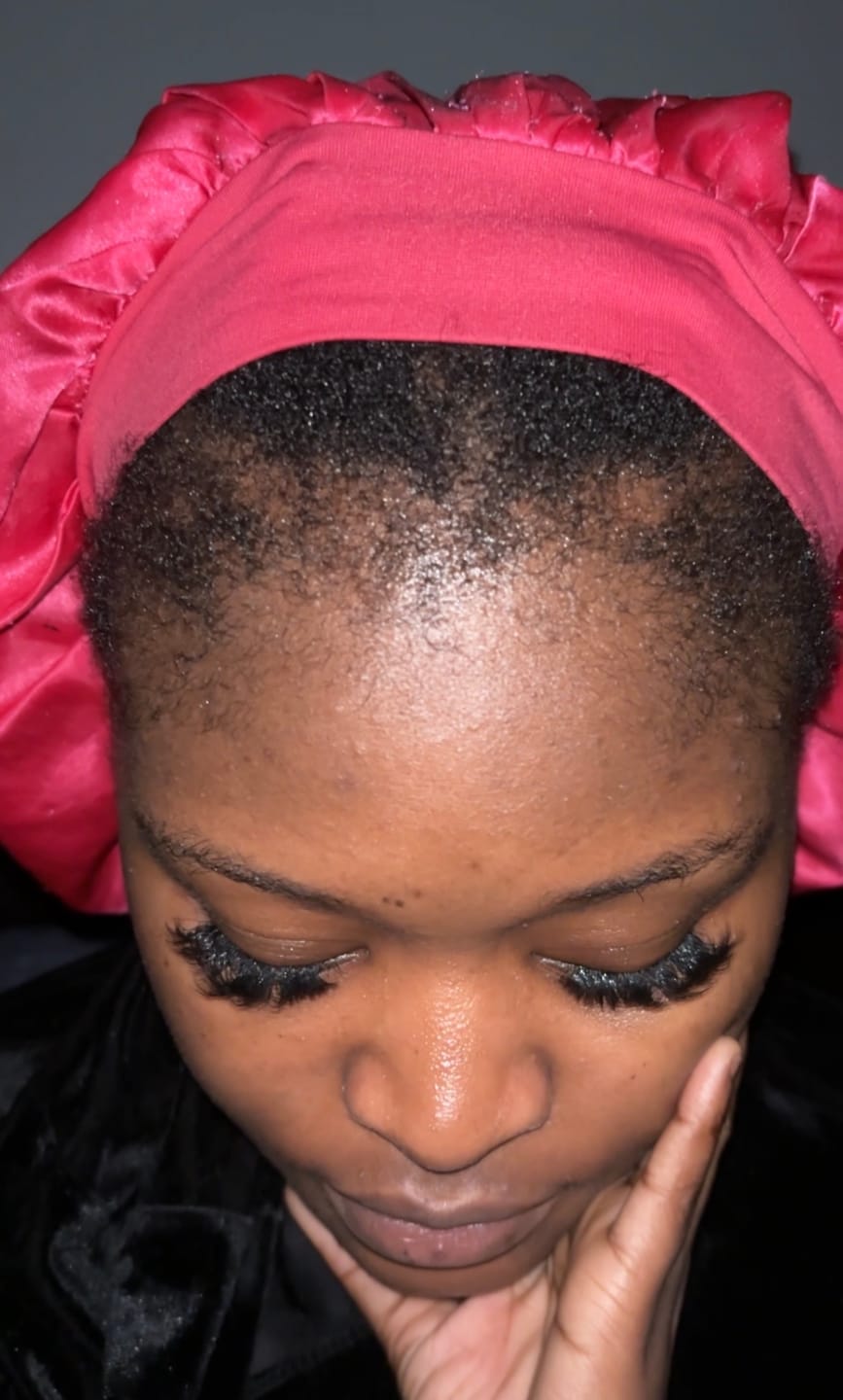 Customer photo review of Minoxidil 5% Solution, 1 x 60ml pack