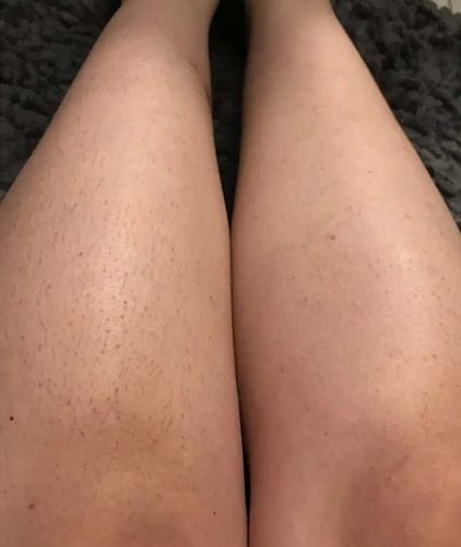 Customer photo review of IPL Max - Permanent Hårfjerner