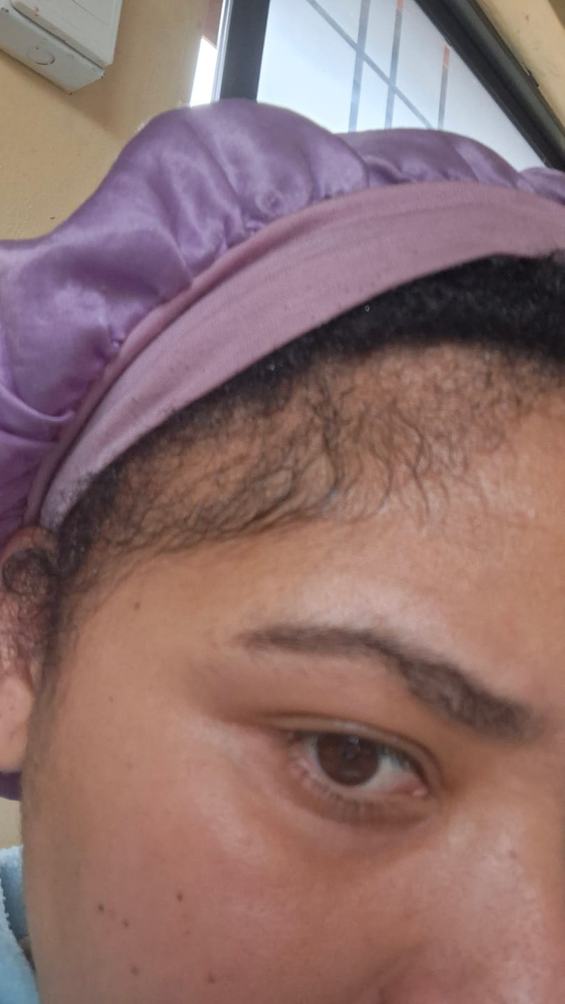 Customer photo review of Minoxidil 5% Solution, 1 x 60ml pack