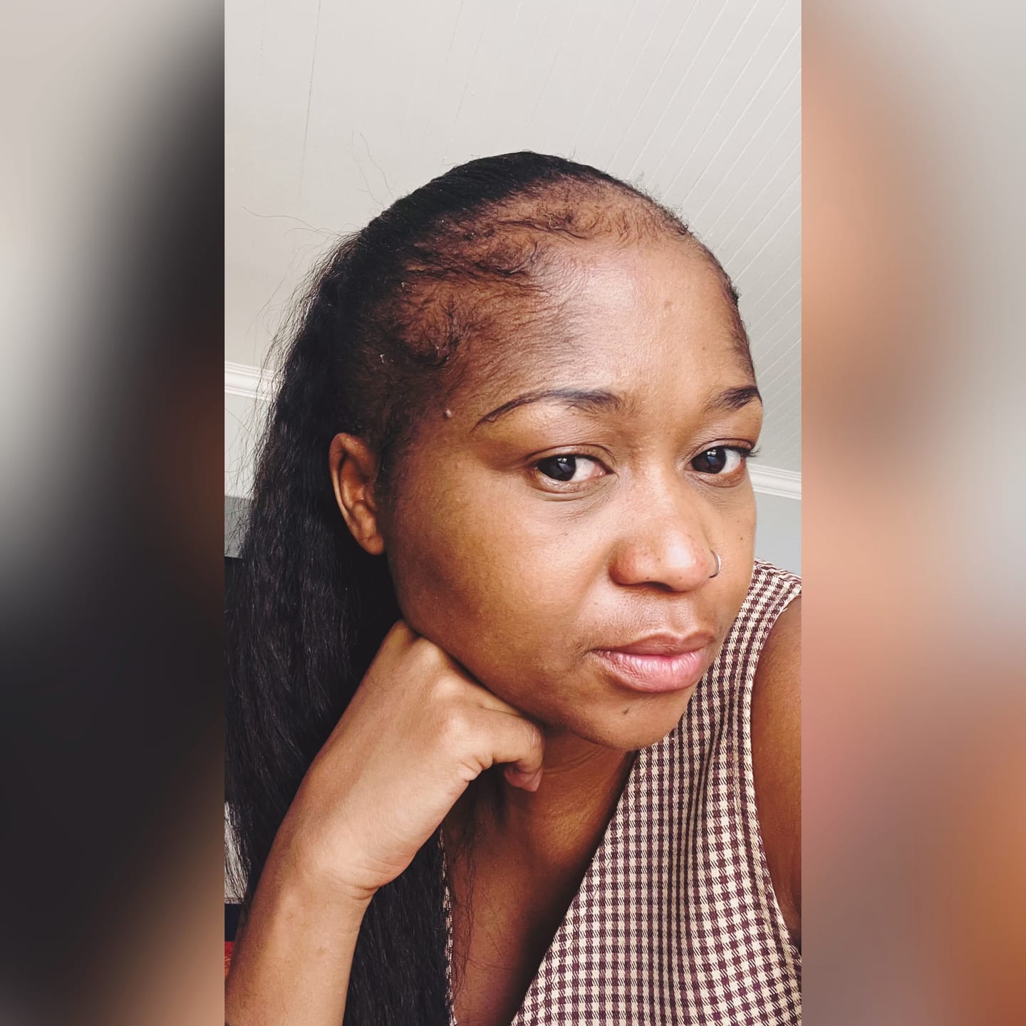 Customer photo review of Minoxidil 5% SOLUTION, 3 x 60ml pack