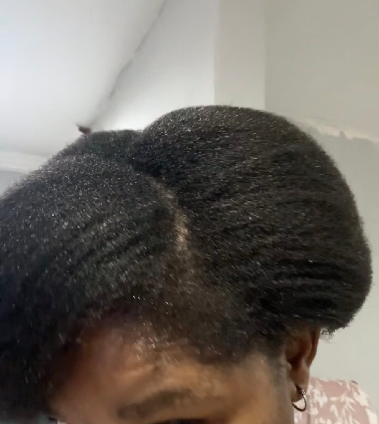 Customer photo review of Minoxidil 5% Solution, 1 x 60ml pack