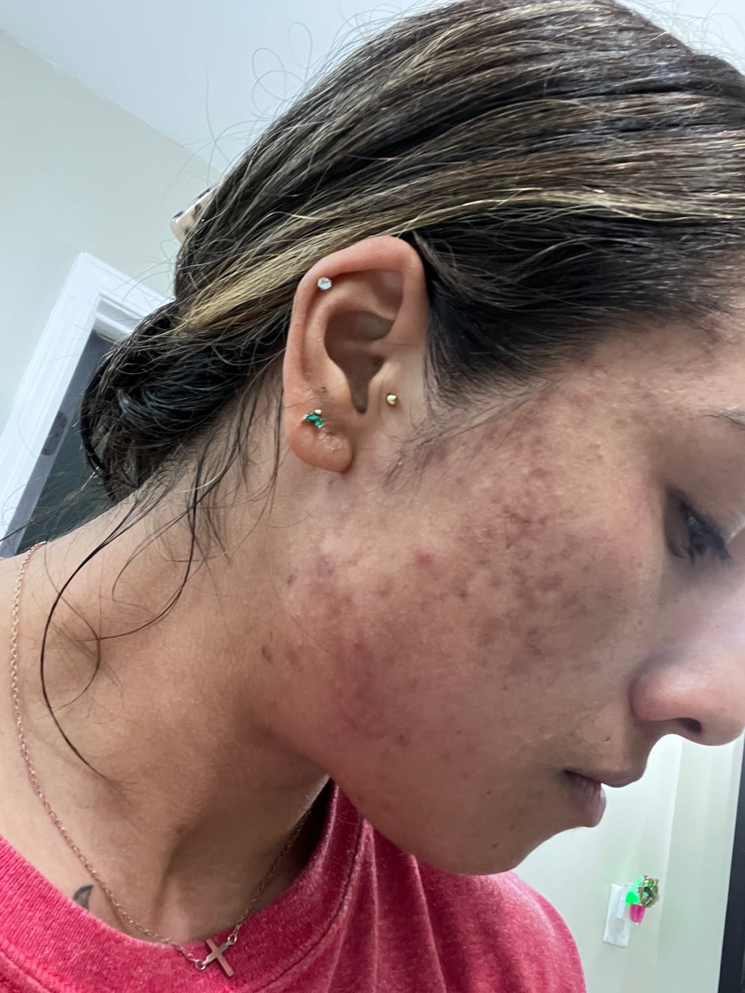 Customer photo review of BeautyPro 2.0 - High Frequency Wand