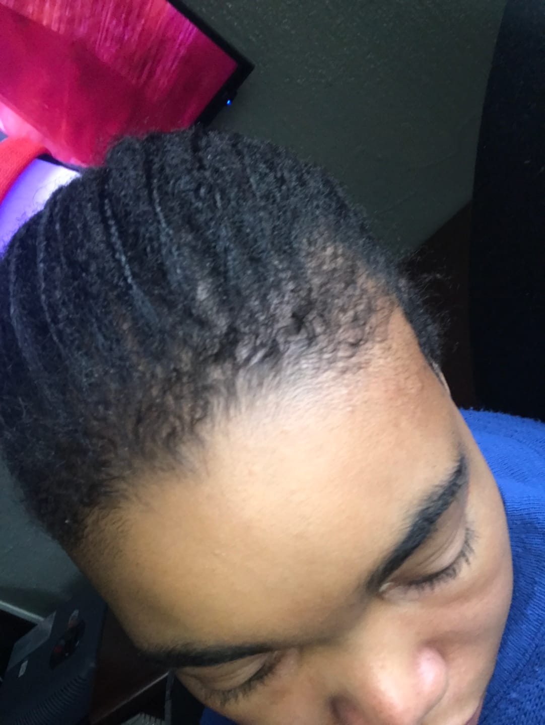 Customer photo review of Minoxidil 5% Solution, 1 x 60ml pack