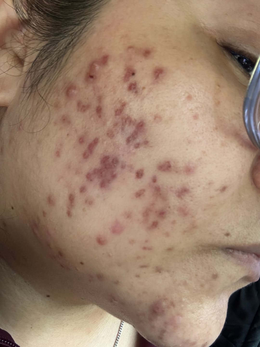 Customer photo review of Kill Acne & Redness Ritual
