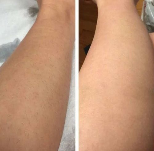Customer photo review of IPL Max - Permanent Hårfjerner