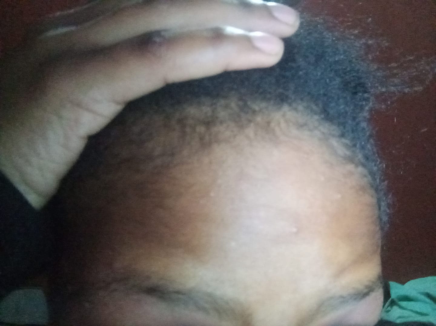 Customer photo review of Minoxidil 5% Solution, 1 x 60ml pack
