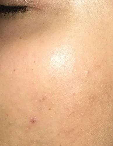 Customer photo review of IPL Max - Permanent Hårfjerner