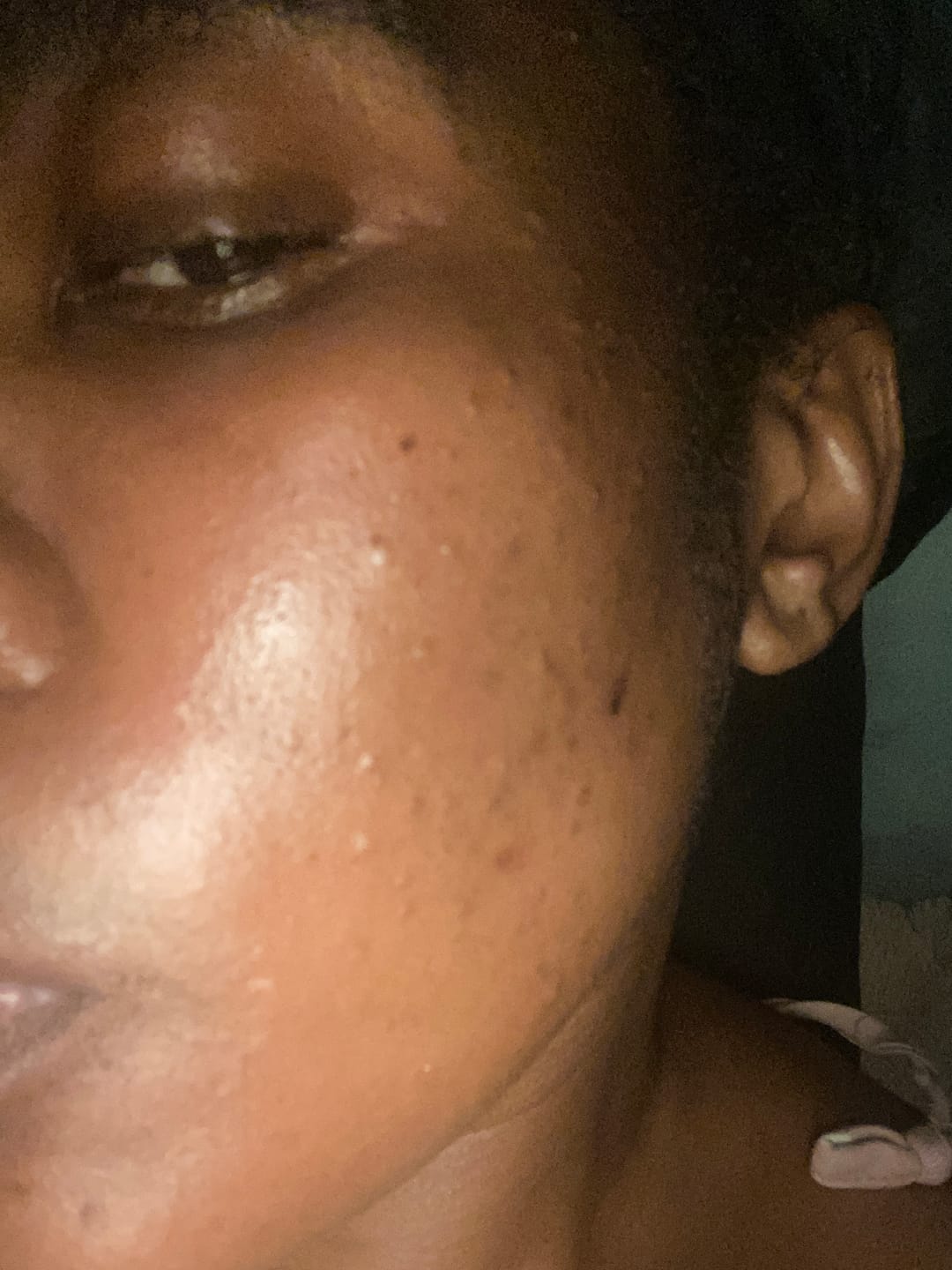 Customer photo review of Minoxidil 5% Solution, 1 x 60ml pack