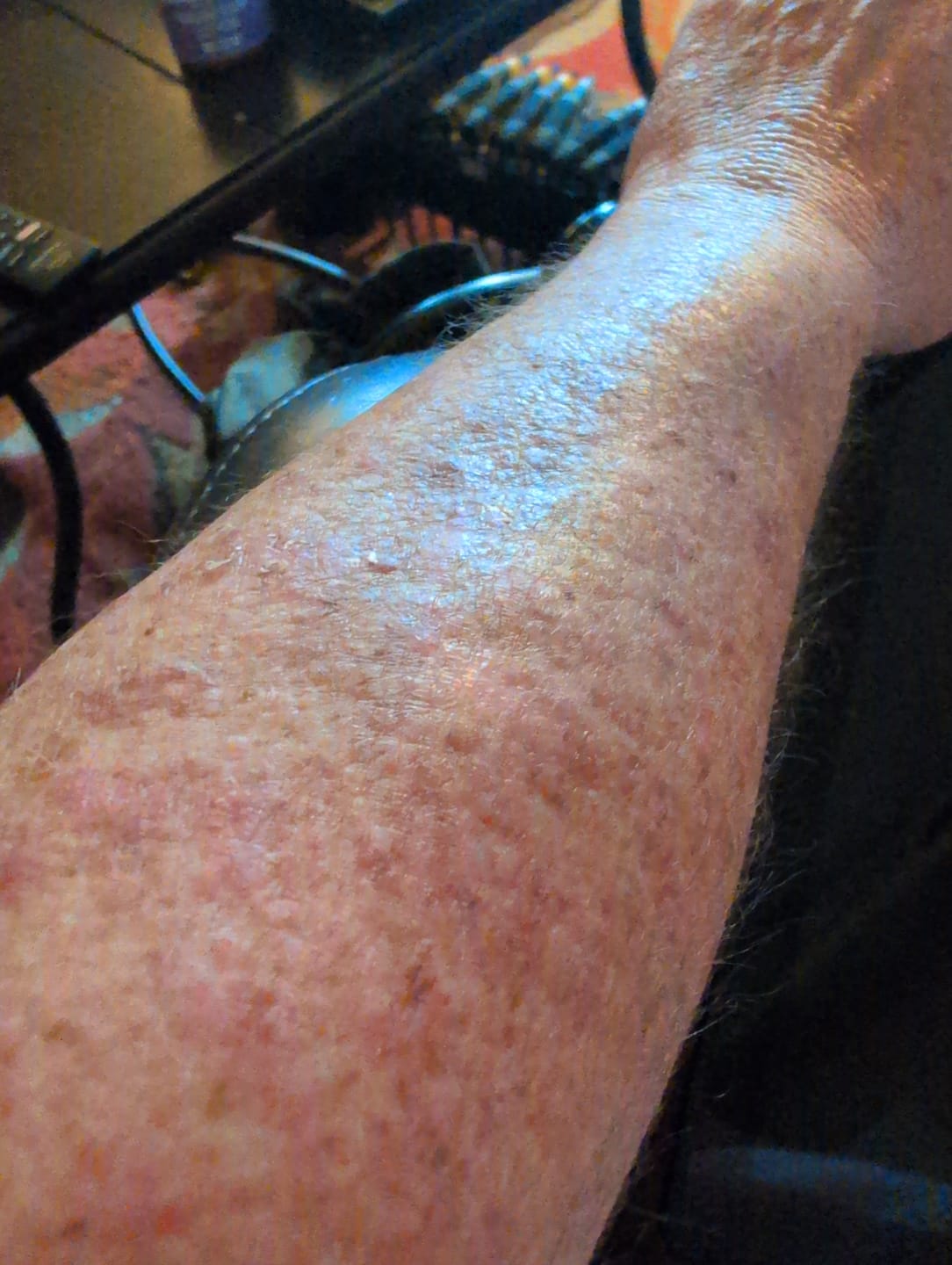 Customer photo review of Best Lotion for Chemo Skin