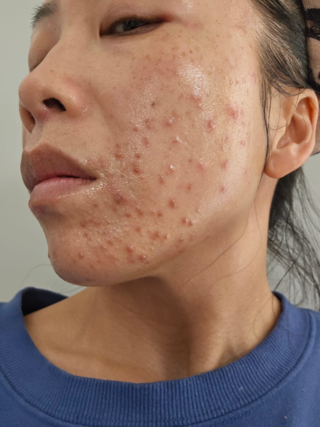 Customer photo review of Acne Formula