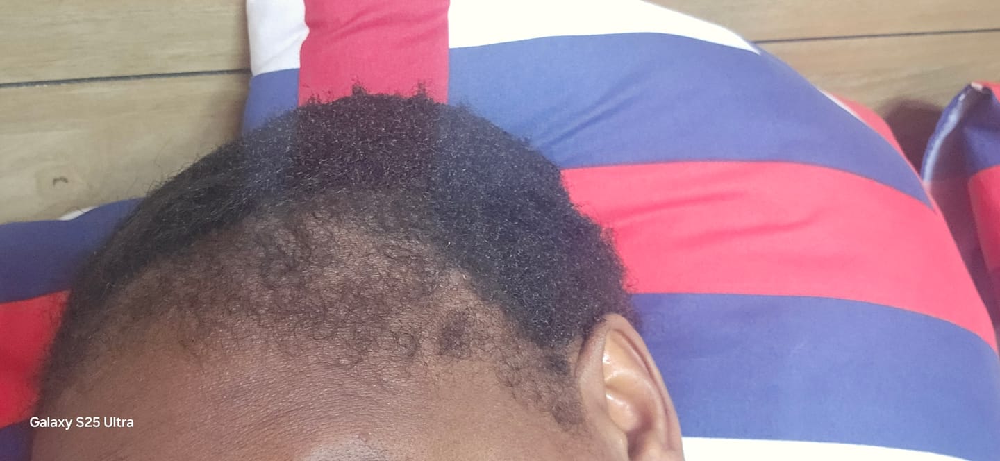 Customer photo review of Minoxidil 5% Solution, 1 x 60ml pack