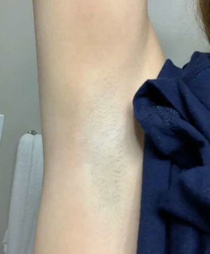 Customer photo review of IPL Max - Permanent Hårfjerner