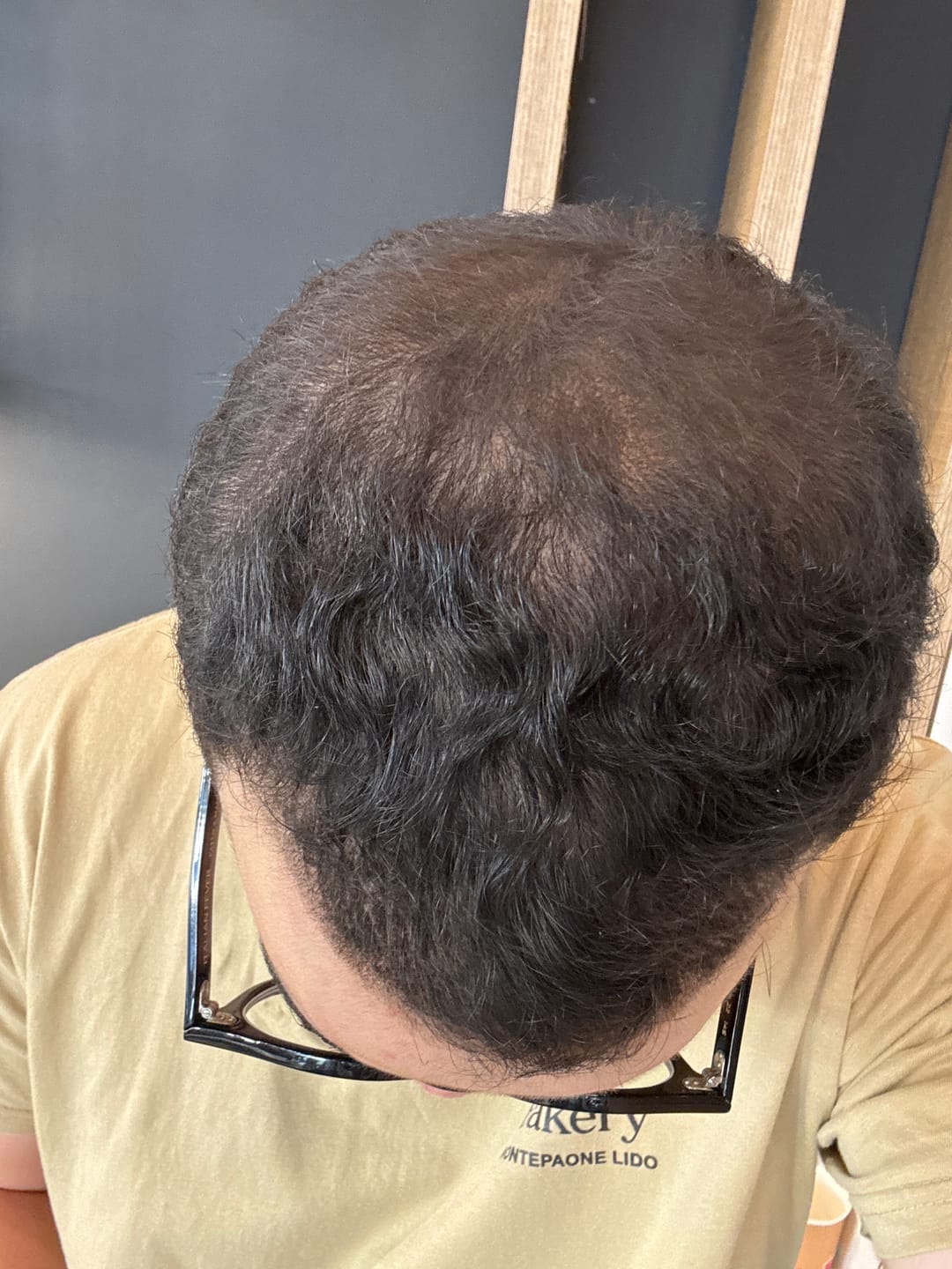 Customer photo review of Fibre copri Calvizie da 12gr  | Castano Scuro | 30 Giorni di applicazioni