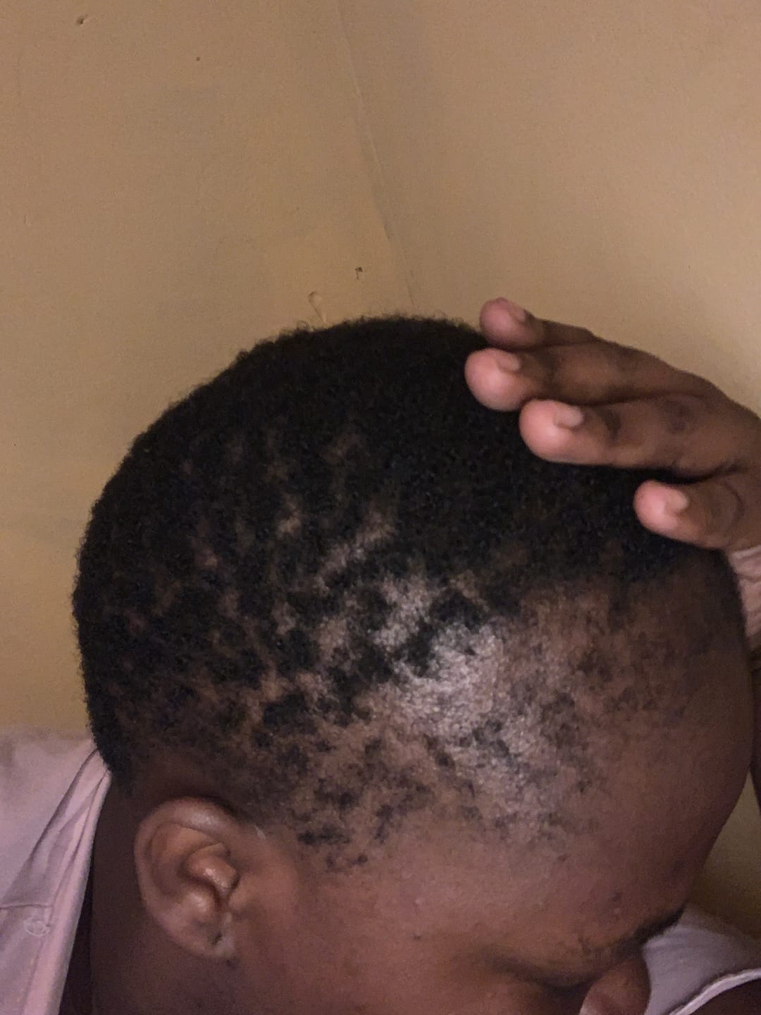 Customer photo review of Minoxidil REGULAR (2%) strength SOLUTION, 1 x 60ml pack