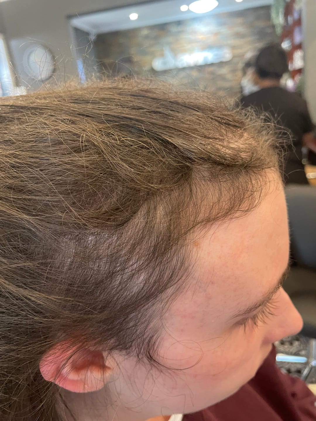 Customer photo review of Minoxidil 5% Foam, 1 x 60ml pack