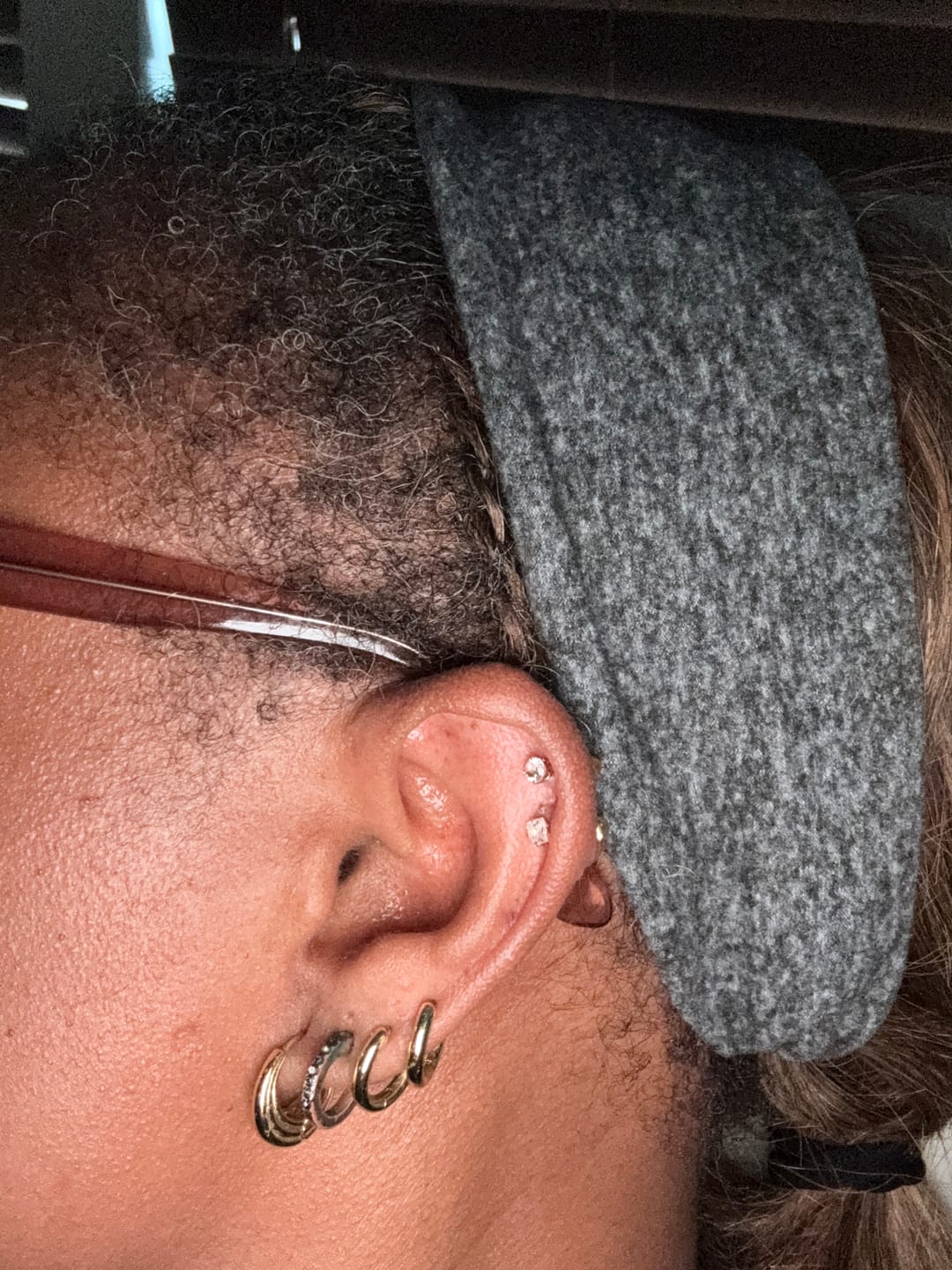 Customer photo review of Piercing Bump Emergency Trio