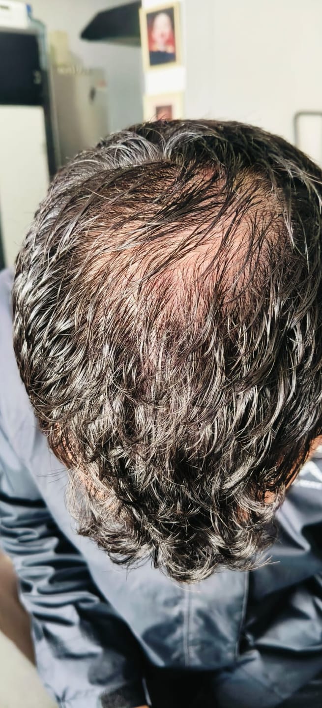 Customer photo review of Minoxidil 5% +DHT Blocker FOAM, MEN ONLY,  3 Month supply
