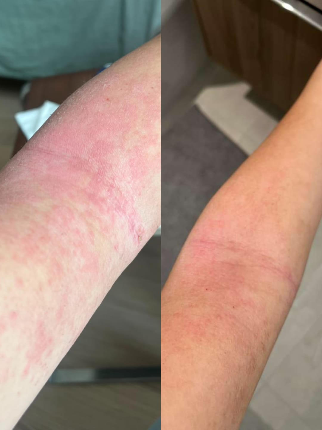 Customer photo review of Eczema Scratch Mitten