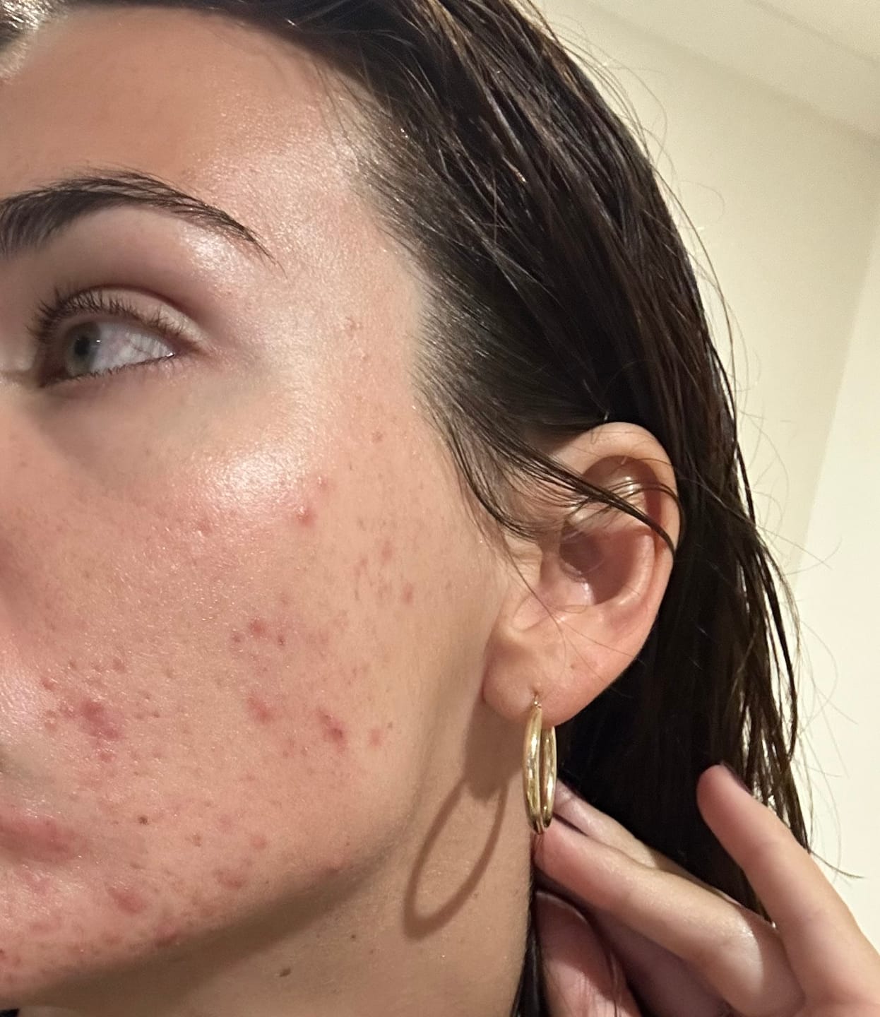 Customer photo review of Azelaic Acid 20% w/w Serum