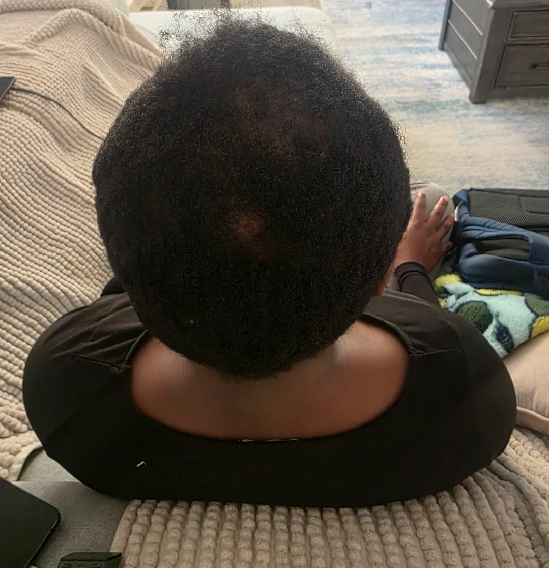 Customer photo review of Ultimate Healthy Hair Care Bundle - Limited Edition