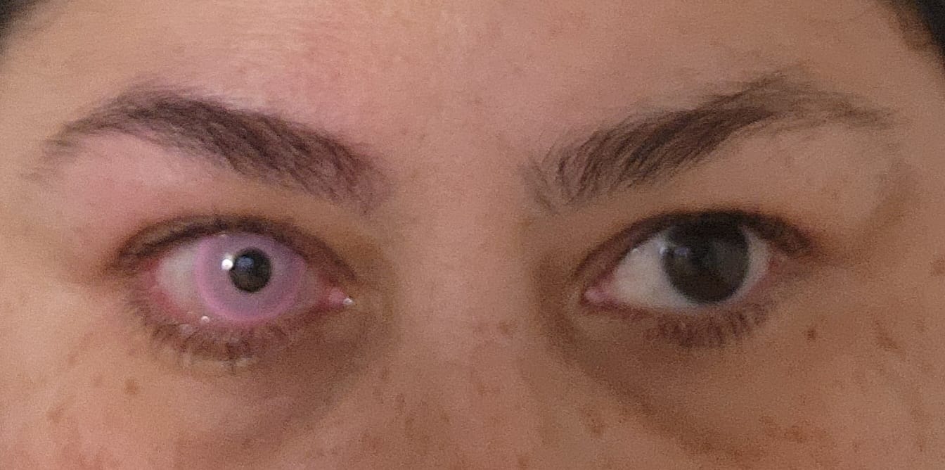 Customer photo review of Cosplay Fluorescent Pink Colored Contact Lenses