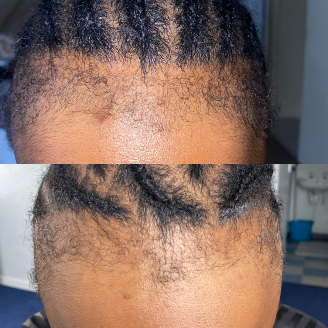 Customer photo review of Minoxidil 5% SOLUTION, 3 x 60ml pack