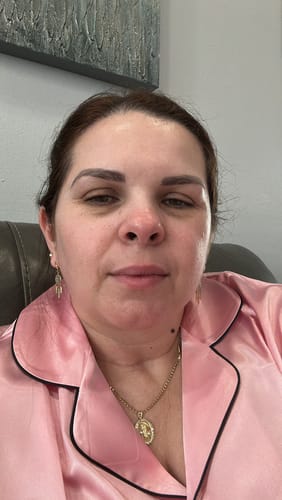 Customer's face before starting treatment with the Seranova Micro Infusion System.