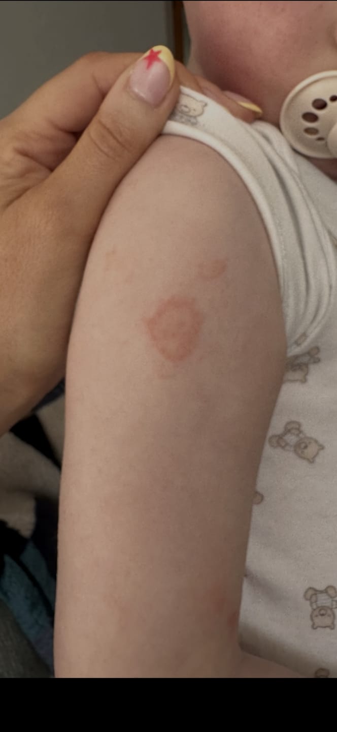 Customer photo review of Bioskin Junior Outbreak Rescue Cream