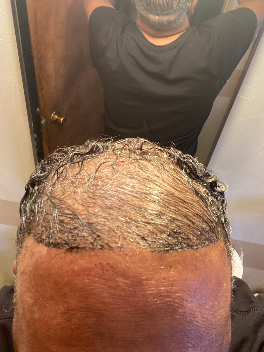Customer photo review of Two Bottles of Rennora Hair Growth Serum