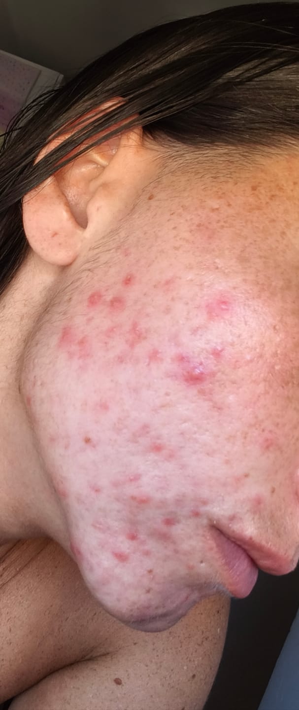 Customer photo review of MIRACLE H -  ÁCIDO HIPOCLOROSO - TÓNICO ANTIBACTERIANO Y ANTIINFLAMATORIO