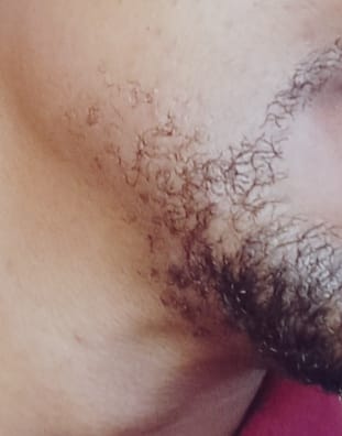 Customer photo review of Minoxidil REGULAR (2%) strength SOLUTION, 3month supply