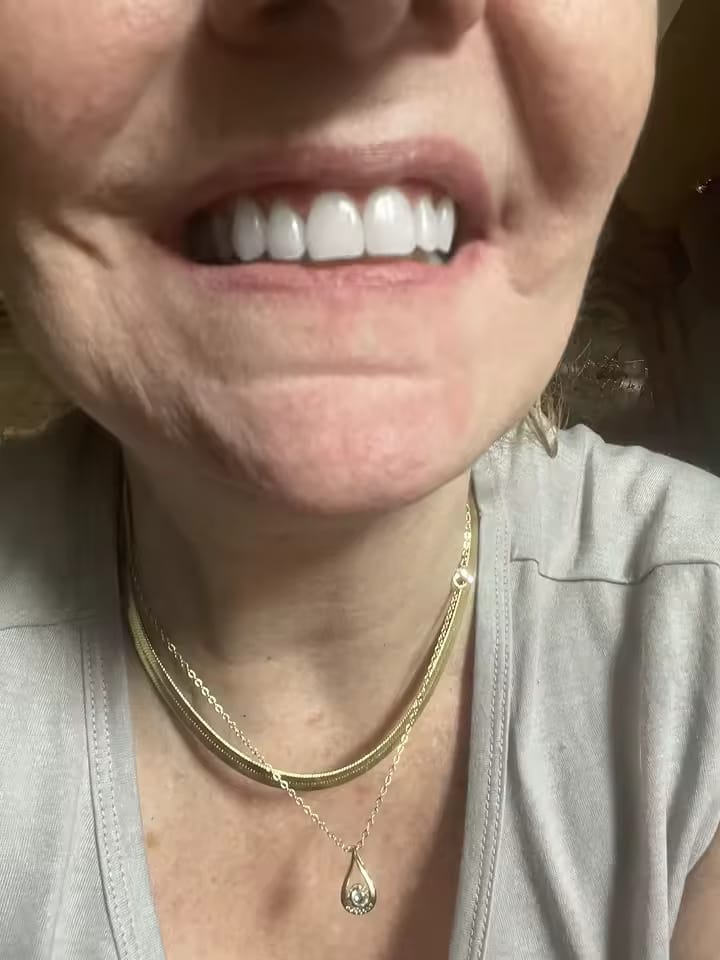 Customer photo review of SparkSmile - V34 (серум за избелване)