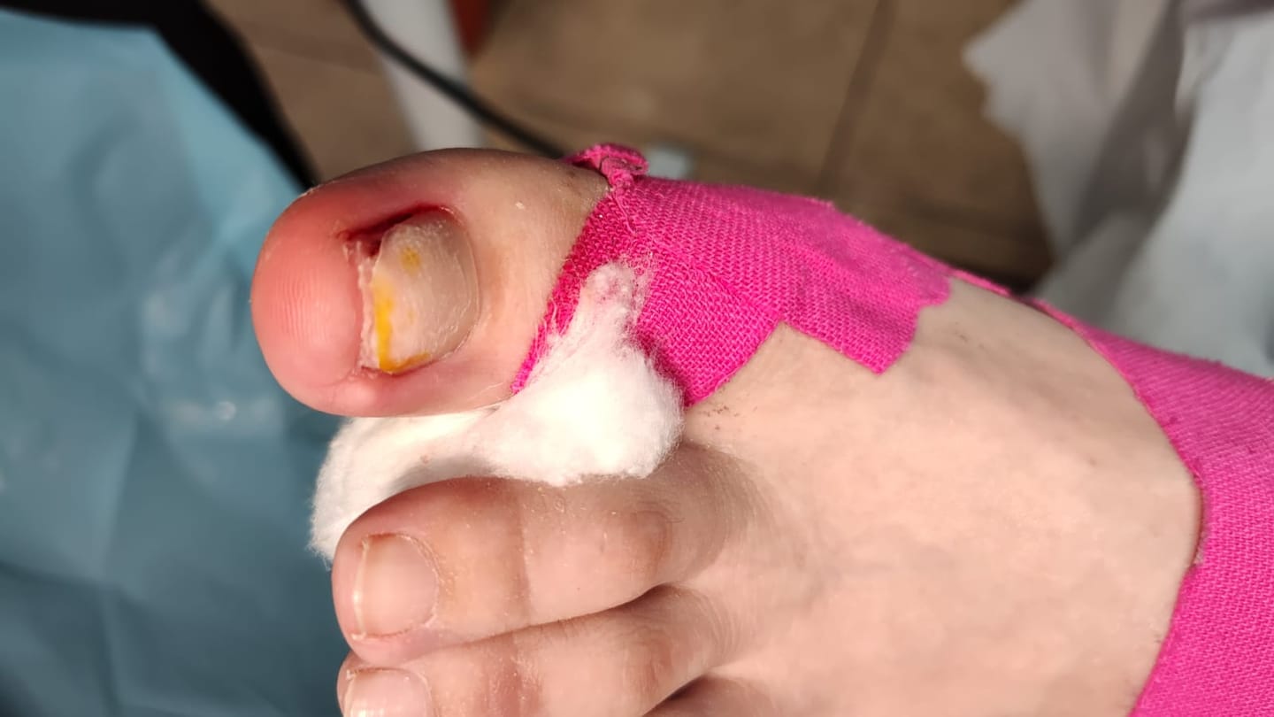 Customer photo review of Gotas ByeBye Hongos – Uñas Sanas & Fuertes