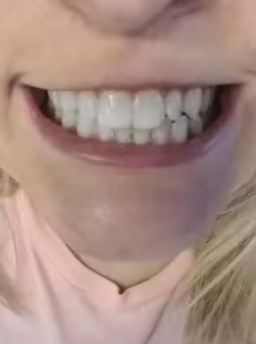 Customer photo review of SparkSmile - V34 (серум за избелване)