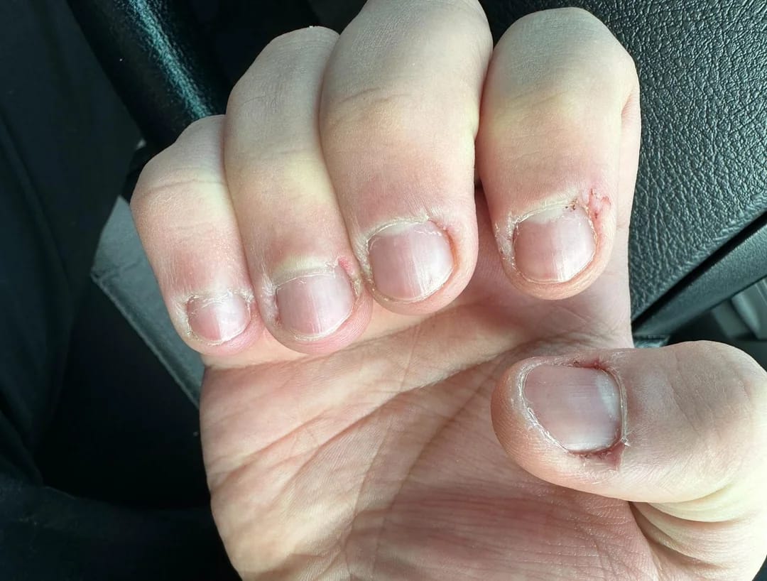 Customer photo review of 30-Day Hand Recovery System