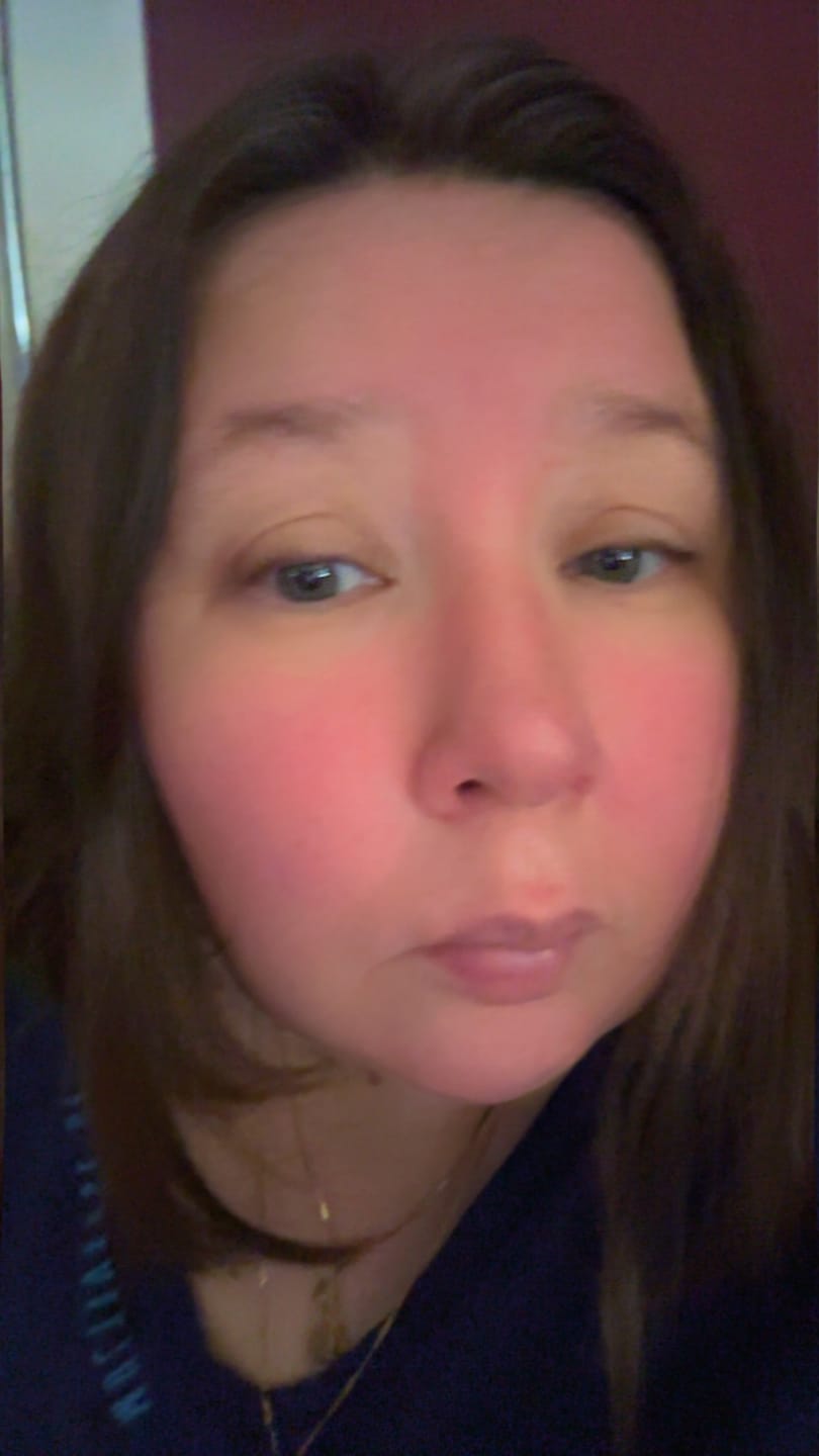 Customer photo review of Instant Rosacea, Acne & Redness Stopper