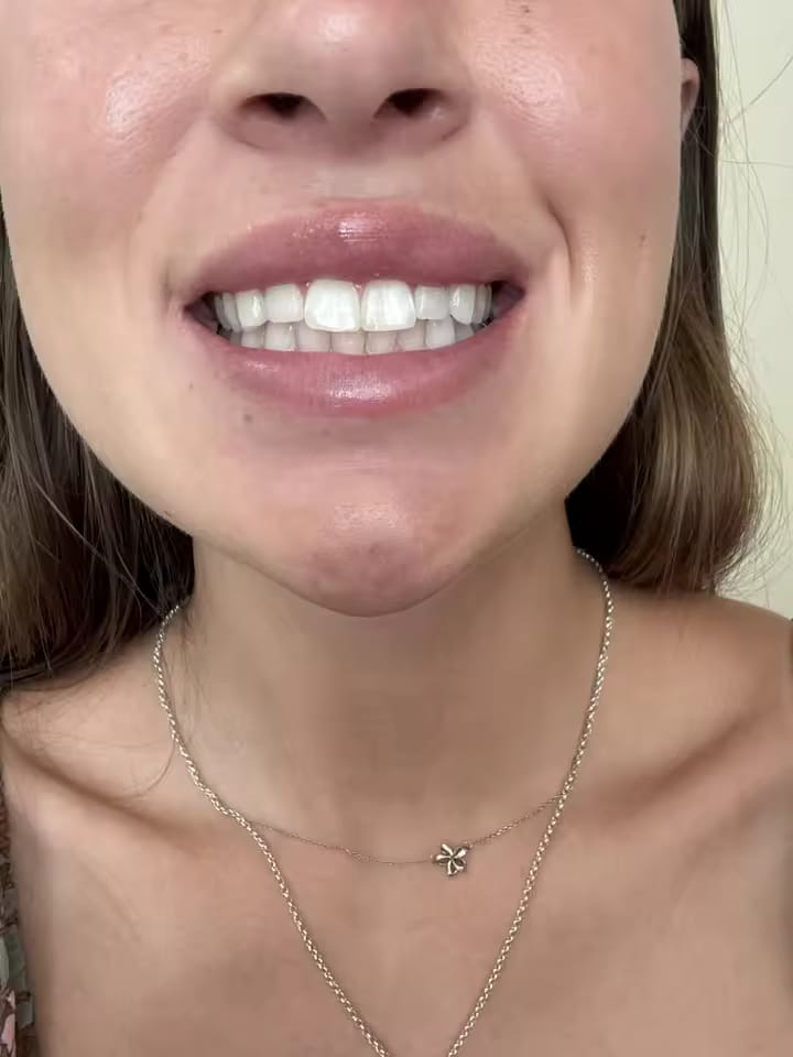 Customer photo review of SparkSmile - V34 (серум за избелване)