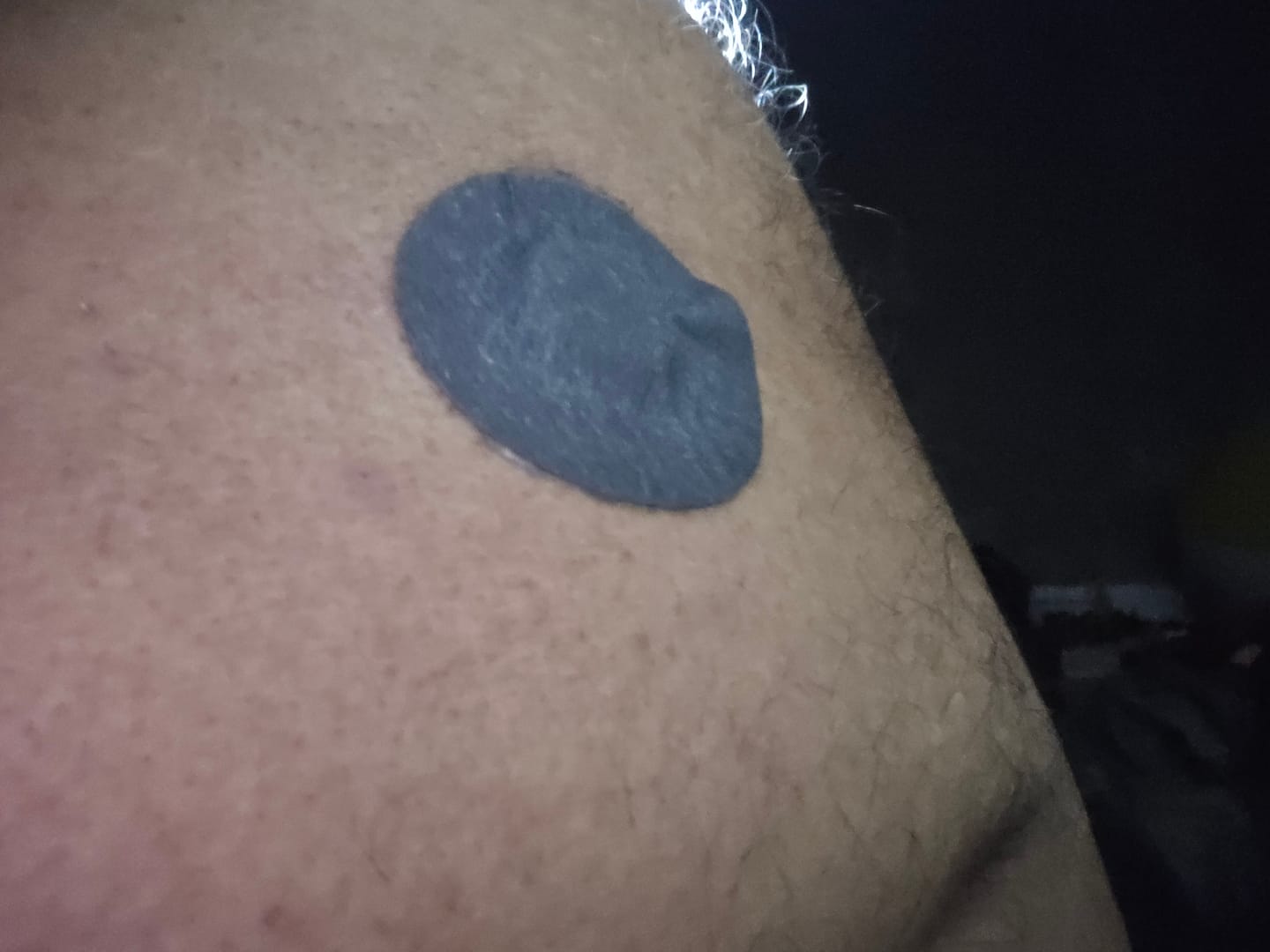 Customer photo review of Skin Grip MAX Freestyle Libre 3+ Patches - 10 Pack OVERSTOCK