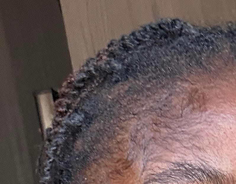 Customer photo review of Minoxidil5% Solution, 1 Pack 60ml