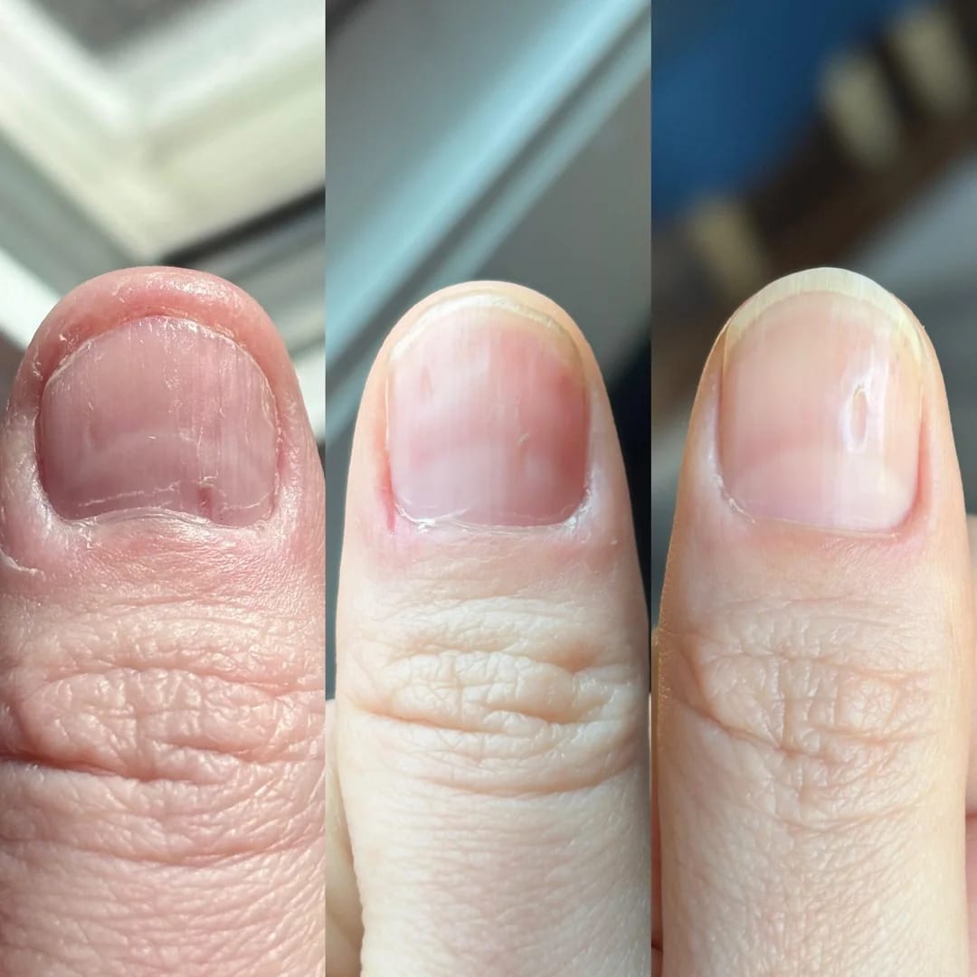 Customer photo review of 30-Day Hand Recovery System