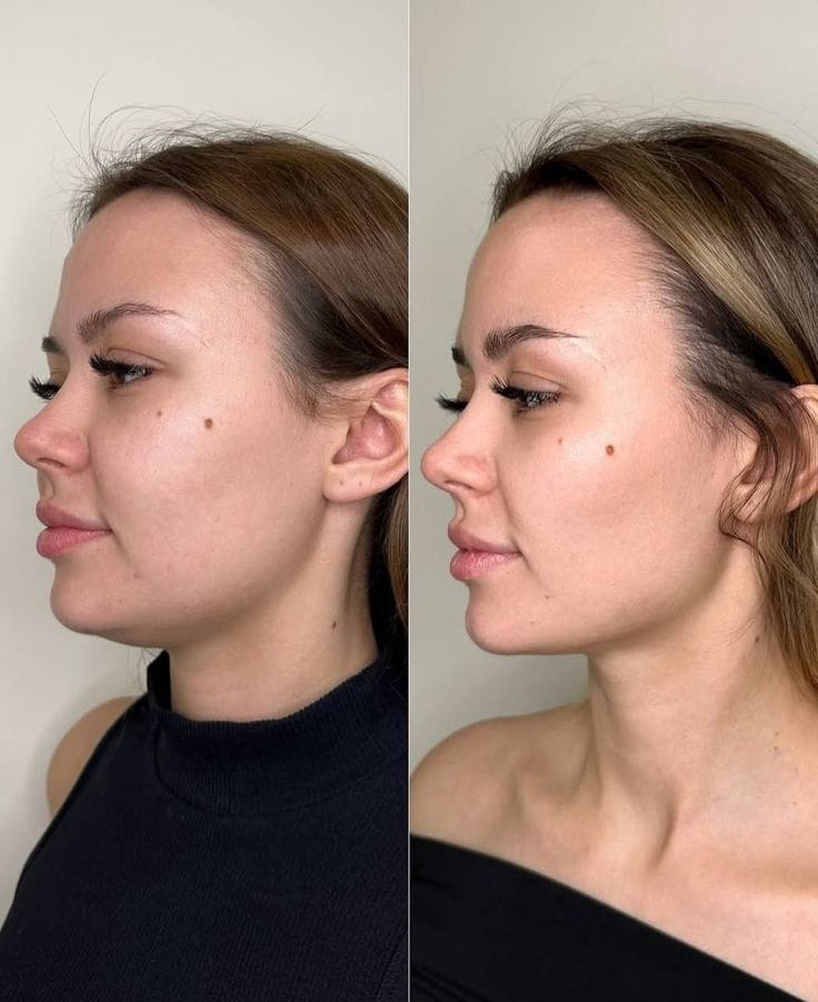 Customer photo review of Drainant Lymphatique BelGlow — Complexe Lympha-4